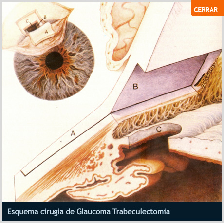 Esquema Cirug&iacute;a de Glaucoma Trabeculectom&iacute;a